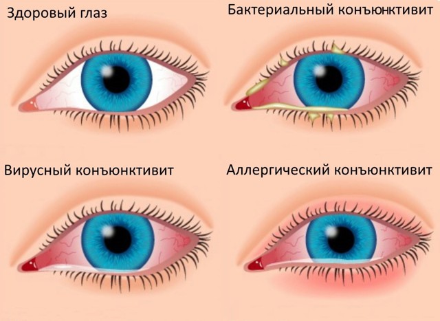 Чем промывать глаза при коньюктивите у взрослых, как правильно промыть глаз