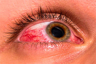 Лекарство от глазного давления: народные средства и препараты снижающие внутриглазное давление, симптомы и лечение заболевания