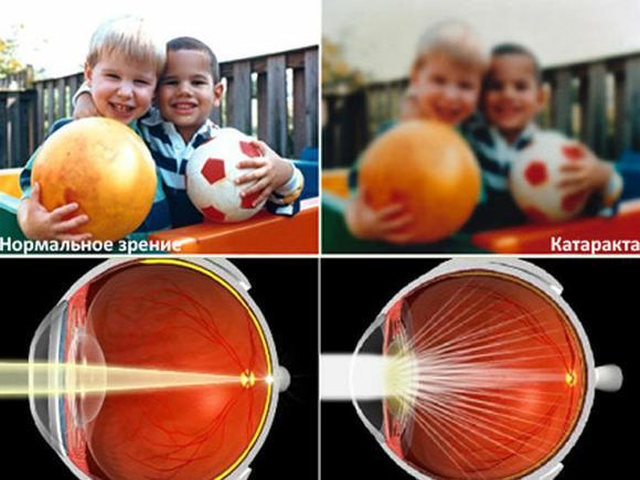 Катаракта глаза причины возникновения, из-за чего развивается у взрослых