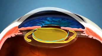 Катаракта - операция по замене хрусталика глаза, какие хрусталики лучше при катаракте
