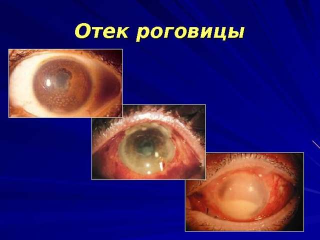 Искусственный хрусталик глаза - срок службы, виды искусственных хрусталиков, их преимущества и недостатки
