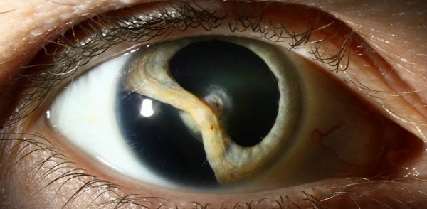 Врожденная катаракта у взрослых: причины и лечение