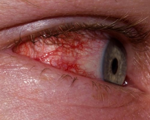Почему болит верхнее и нижнее веко глаза - причины боли век обоих глаз