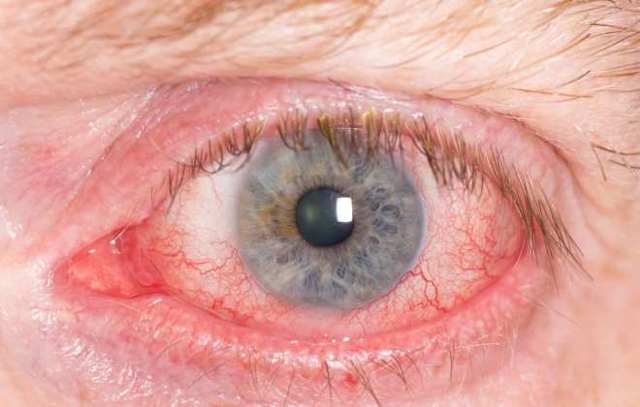 Осложнения после операции катаракты глаз: отек роговицы, астигматизм, болит глаз, не видит