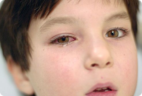 Глаз продуло: симптомы и лечение, чем лечить у ребенка?