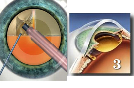 Как лечится катаракта ультразвуком - ультразвуковая операция
