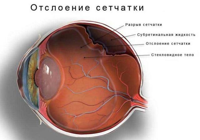 Глазное давление симптомы и лечение, норма внутриглазного давления