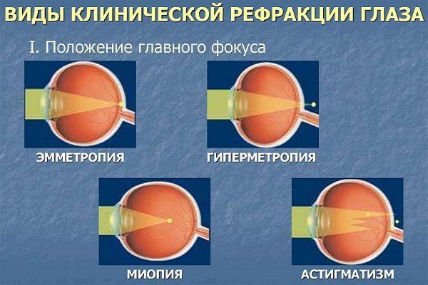 Мутное зрение - причины помутнения и затуманивания зрения, размытое изображение в одном глазу