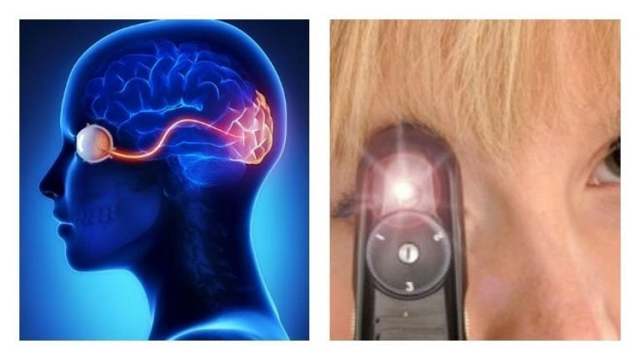 Неврит зрительного нерва, воспаление глазного нерва симптомы и лечение