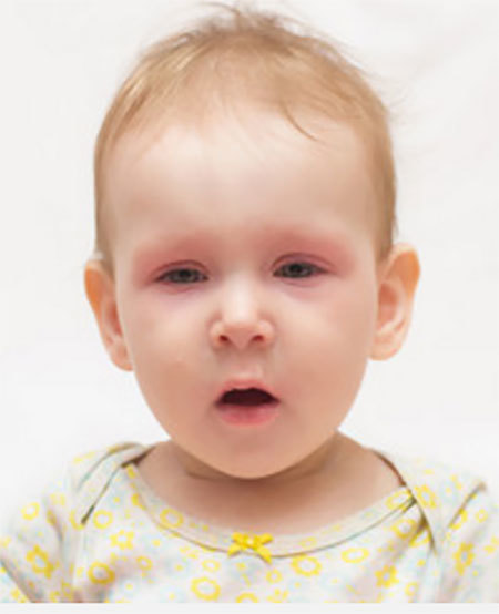 Аллергический конъюнктивит у детей, симптомы и лечение у ребенка