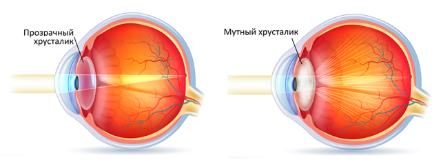 Лечение катаракты народными средствами без операции