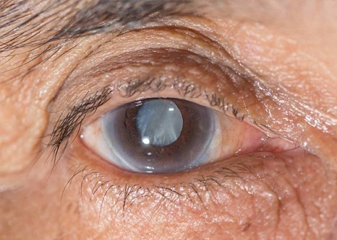 Начальная катаракта - лечение начальной стадии катаракты