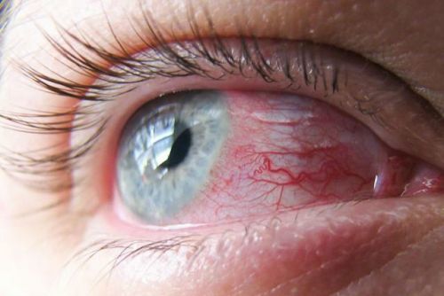 Болит глаз при моргании, нижнее веко, уголок глаза - что делать?