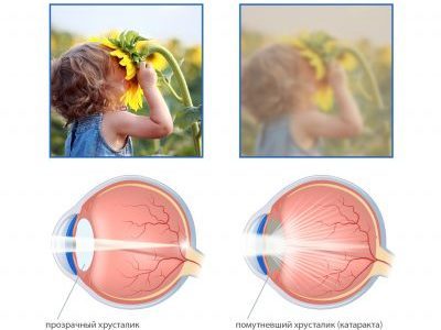 Операция при катаракте: как делают удаление катаракты, наркоз при операции