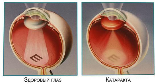 Факоэмульсификация катаракты с имплантацией ИОЛ - что это такое? Осложнения после операции