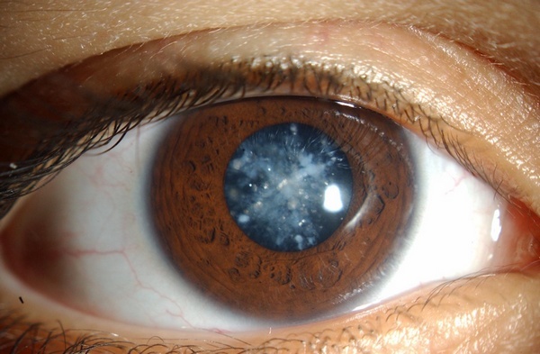 Катаракта глаза причины возникновения, из-за чего развивается у взрослых