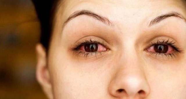 Эписклерит: симптомы и лечение, причины заболевания глаза у детей