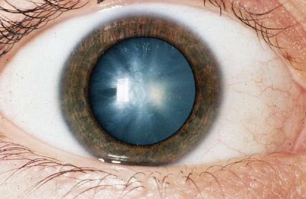 Профилактика катаракты глаз, как предотвратить катаракту народными средствами