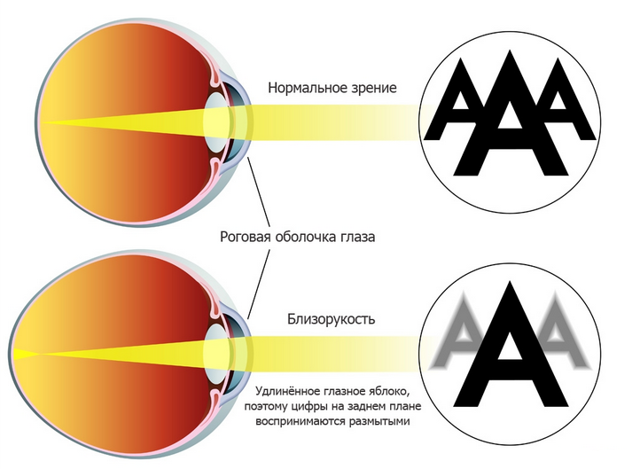 Капли для глаз для улучшения зрения при близорукости