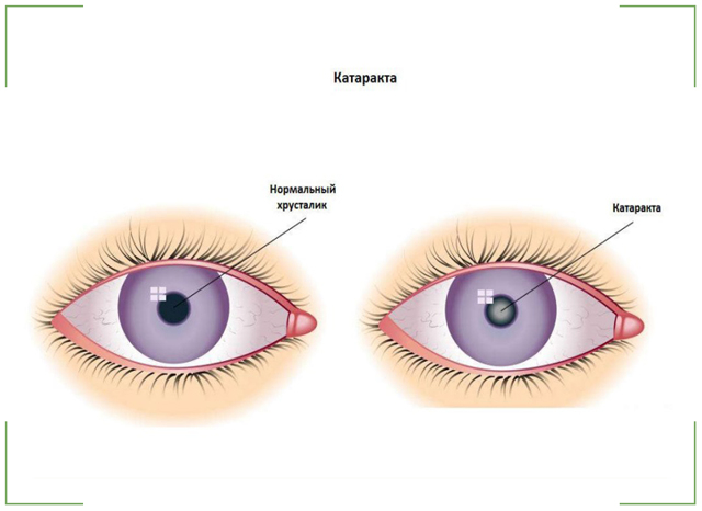 Как лечится катаракта ультразвуком - ультразвуковая операция