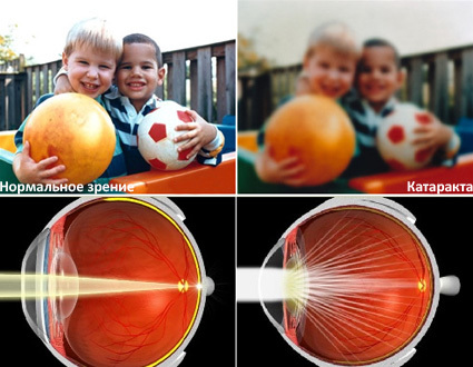 Катаракта: симптомы и признаки катаракты глаза на ранней стадии