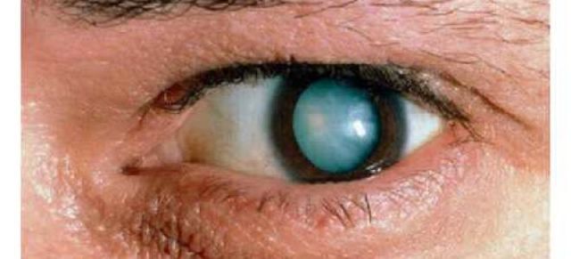Врожденная катаракта у взрослых: причины и лечение