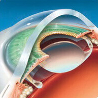 Лечение катаракты народными средствами без операции