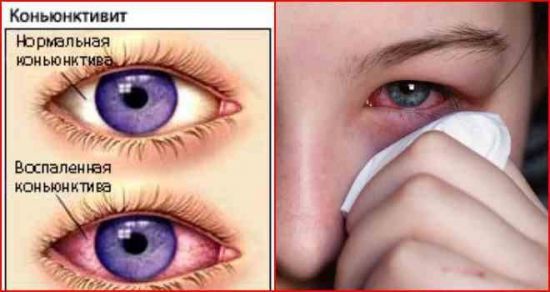 Воспаление глаза, чем лечить и что делать если воспалился глаз
