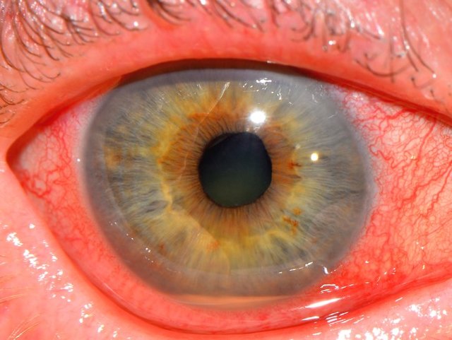 Воспаление радужной оболочки глаза - это ирит, хронический тип ирита
