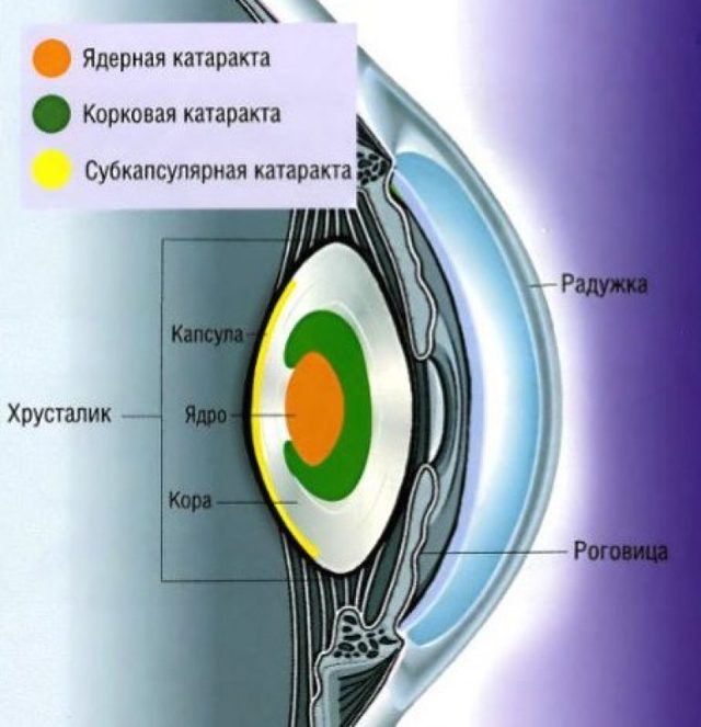 Ядерная катаракта глаз у пожилых, что это такое?