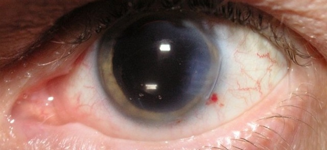 Катаракта при близорукости: миопия, осложненная катарактой