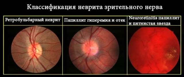 Неврит зрительного нерва, воспаление глазного нерва симптомы и лечение