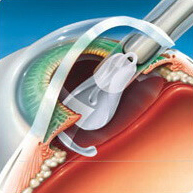 Операция катаракты, анализы для проведения операции, как их сдают