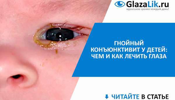 Гнойный коньюктивит глаз: лечение у детей, чем лечить у ребенка?