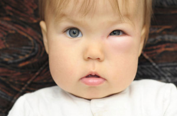 Ребенка укусила мошка в глаз - что делать и чем снять отек, если опухло веко
