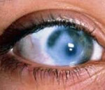 Бельмо на глазу, помутнение роговицы глаза: причины и лечение