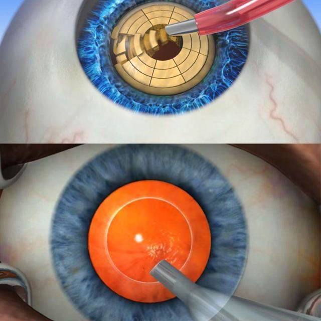Лечение катаракты лазером: фемтолазерная хирургия против экстракапсулярной экстракции