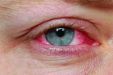 Хронический конъюнктивит глаз: лечение и симптомы у взрослых
