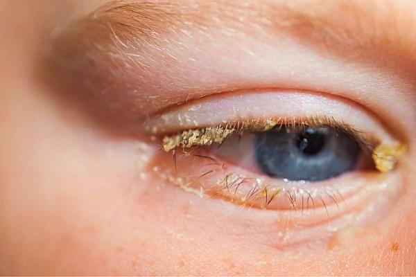 Чем промывать или протирать глаза при коньюктивите у детей
