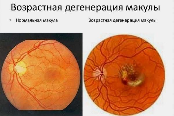 Мутное зрение - причины помутнения и затуманивания зрения, размытое изображение в одном глазу