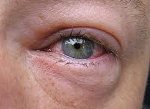 Аллергический конъюнктивит: лечение глаз и симптомыу взрослых