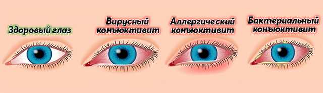 Выделения из глаза у взрослого, почему в глазах появляются белые или зеленые нитевидные выделения