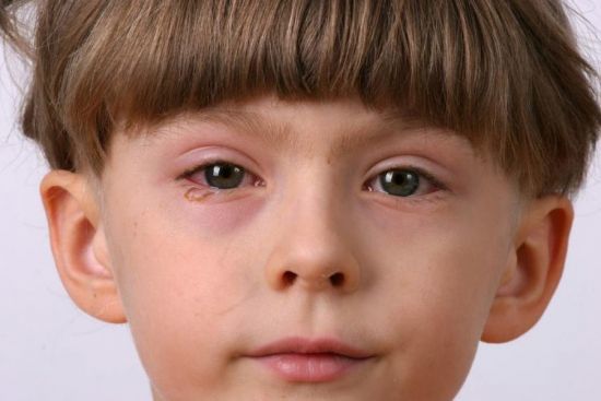 Воспалился глаз у ребенка, чем и как лечить воспаление глаза, капли для лечения