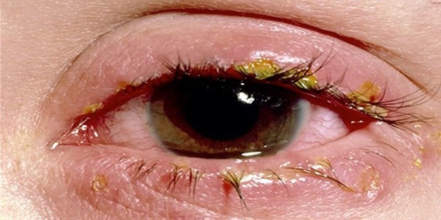 Глазные капли от аллергического конъюктивита у взрослых