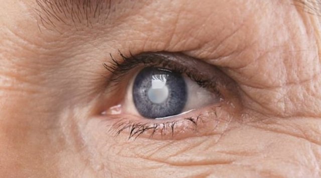 Профилактика катаракты глаз, как предотвратить катаракту народными средствами