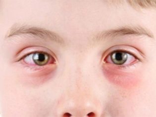Вирусный коньюктивит глаз: симптомы и лечение у детей вирусного конъюнктивита, чем и как лечить у ребенка