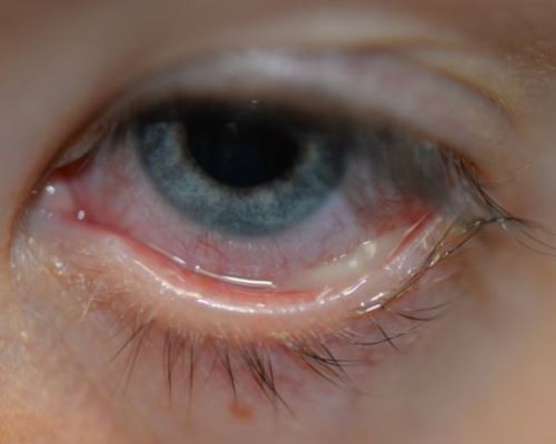 Почему болит верхнее и нижнее веко глаза - причины боли век обоих глаз