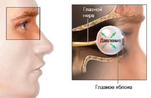 Как снять глазное давление в домашних условиях, чем его снизить и лечить, оказание помощи при внутриглазном давлении