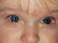Бактериальный конъюнктивит у детей: лечение
