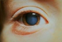 Сумеречное зрение - нарушение и ухудшение сумеречного зрения, недостаток витамина